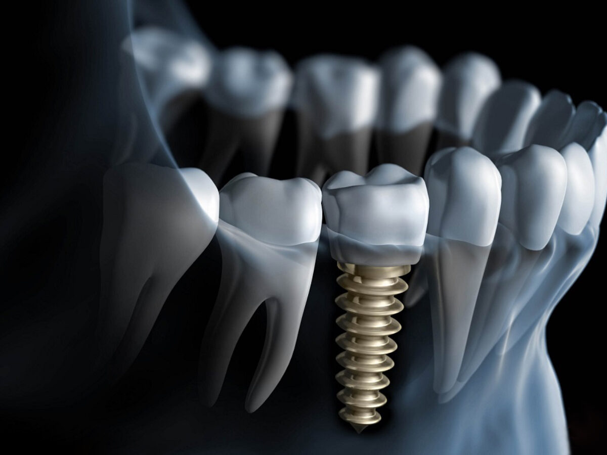 //www.erkamsofuogludisklinigi.com/wp-content/uploads/2022/02/dental-implants-1200x900-1.jpg
